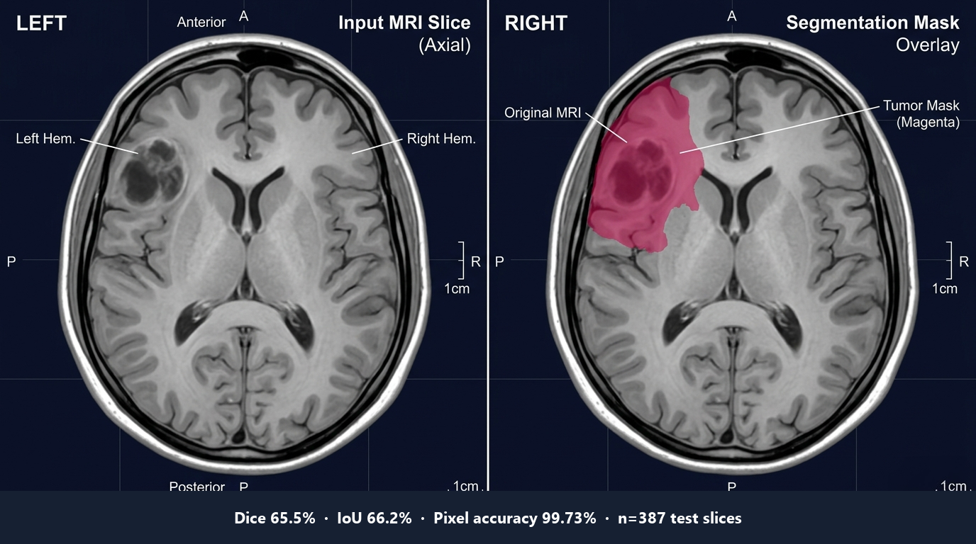 brain-mri-segmentation · SegFormer-B2 tumor mask overlay