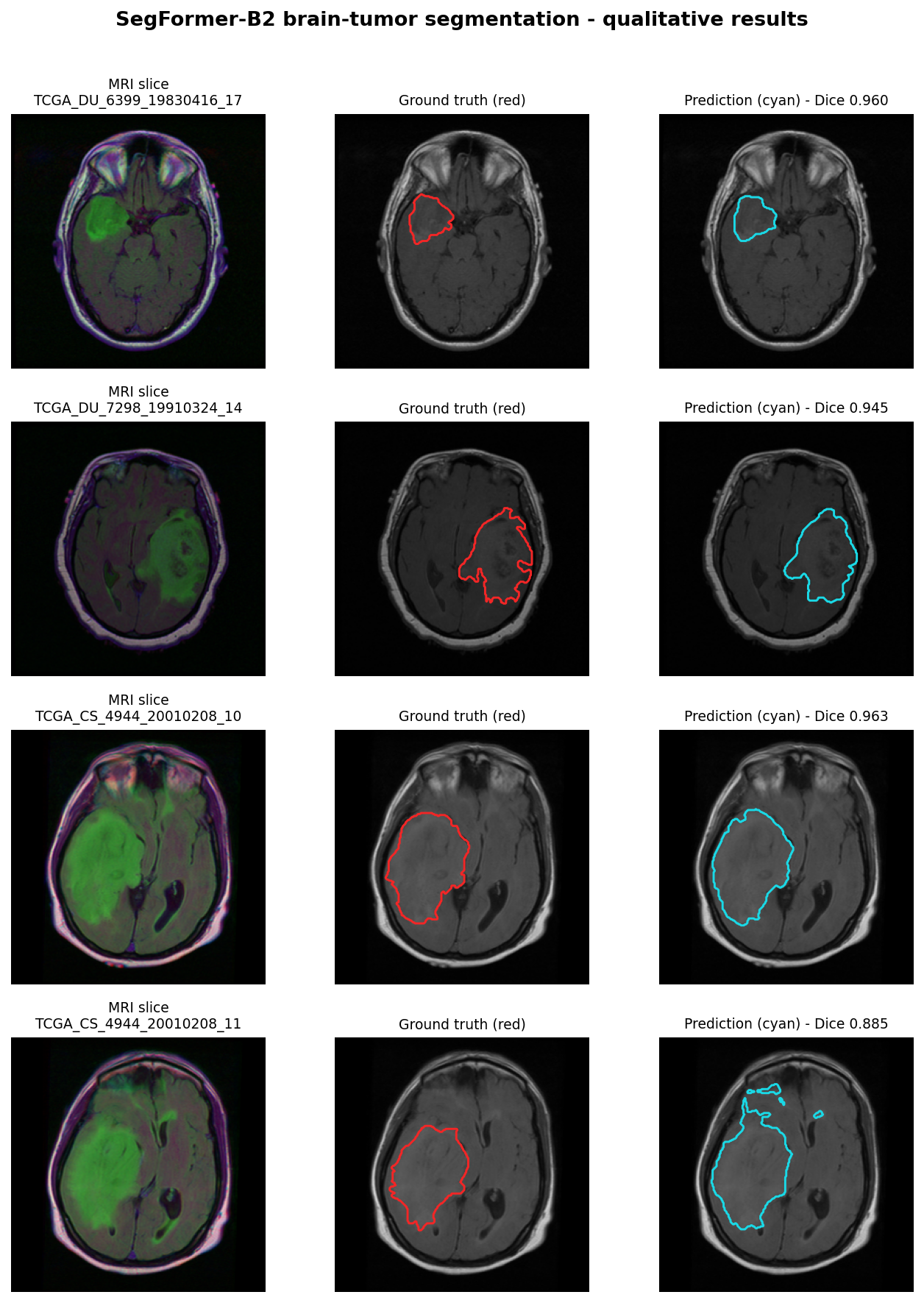 Qualitative segmentation panel - input MRI, ground truth, and SegFormer-B2 prediction